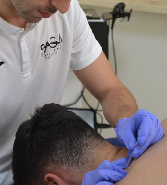 Punción seca Clínica de Fisioterapia y Osteopatía SAGA